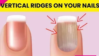 Don’t Ignore if Vertical Ridges on Your Nails.#nails #ai nails#instagram Nails