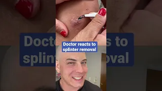 Doctor reacts to splinter removal!