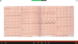 Atrial Tachycardia EP STUDY and Ablation Dr  Lamyaa Allam