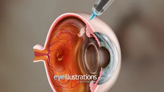 Macular Degeneration Treatment - Intravitreal Injection into the eyeball