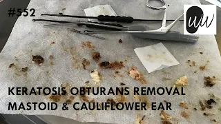 552 - Keratosis Obturans Removal from Mastoid & Cauliflower Ear