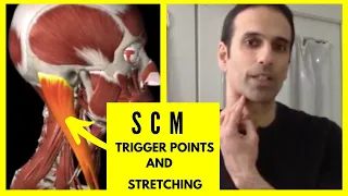 Dizziness, headaches, and neck pain from SCM trigger points