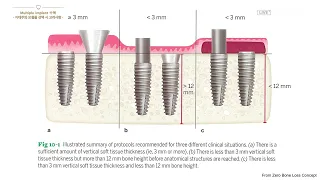 [OSSTEM] PROSTHODONTICS: Consideration for Selecting Abutments and Prosthesis