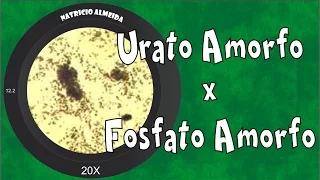 Cristais de urato amorfo e fosfato amorfo na urina