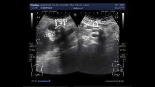 Ultrasound Video showing Pyonephrosis with multiple renal and ureteric stones.