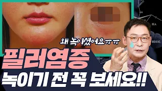 필러 염증, 무조건 녹이지 마세요! ※녹이지 않고 해결하는 방법 전격공개 ※