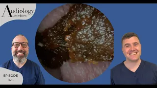 GOLDEN SYRUP EAR WAX & 3 MORE EAR WAX REMOVAL - EP826