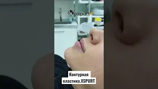 Контурная пластика губ препаратом XSPURT
