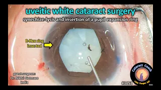 CataractCoach 1151: dense whie cataract with uveitis and synechiae