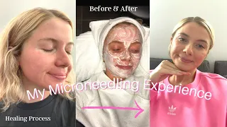 MICRONEEDLING VLOG: Before & After, Is it worth it, Microneedling for acne scars & pores, Results