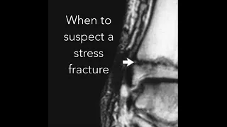 Suspect a stress fracture? with Tom Goom