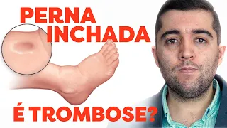 Como melhorar a perna inchada e sua relação com circulação? É trombose, embolia ou artéria entupida?