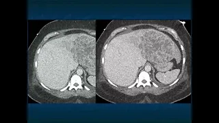CT Evaluation of Liver Masses: Key Differential Diagnosis Pathways - Part 4