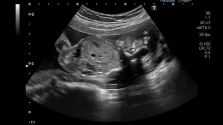 Ultrasound Video showing Anencephaly.