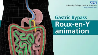 Gastric Bypass | Roux-en-Y animation