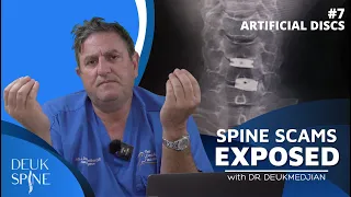 Artificial Disc Replacement Complications. (Ep.7 Spine Scams)