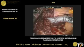 Robotic multi-visceral resection for pancreatic neuroendocrine tumor with liver metastasis