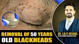 REMOVAL OF 50 YEARS OLD BLACKHEADS II Dr. Lalit Kasana's