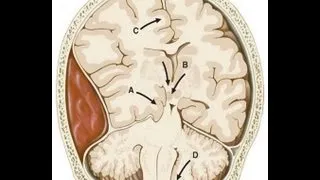 Brain Injury-Dr. Ed Park's Podcast 38