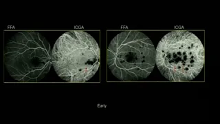 AIOC2018 - IC005 - Topic - Imaging in uveitis – FFA; ICG;  OCT &  OCTA - Dr.Reema Bansal