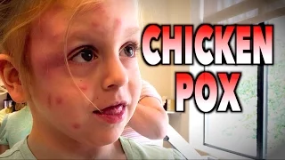 CHICKENPOX? (Unusual Presentation) | Dr. Paul (Varicella)