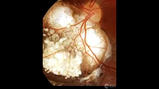 Stereophotography of a retinoblastoma (after treatment) Courtesy of @marback1972