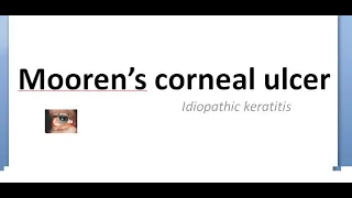 Ophthalmology 125 b Mooren Ulcer Idiopathic Corneal Cornea Immune mediated autoimmune condition PUK