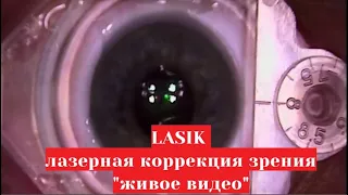 ЛАСИК  - "живое" видео 😲 операции лазерной коррекции зрения по методу LASIK в Москве