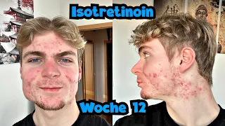 STARKE Nebenwirkungen und co.! Isotretinoin Tagebuch Woche 12