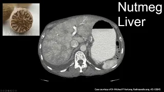 Interpreting CT Abdo: Nutmeg Liver - Passive Congestion, Budd Chiari, and SOS