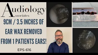 9CM/3.5 INCHES OF EAR WAX REMOVED FROM 1 PATIENT - EP616