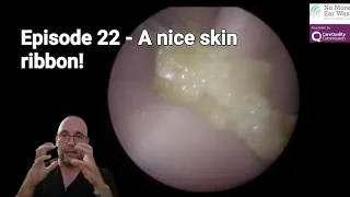 Episode 22 - A nice skin ribbon!