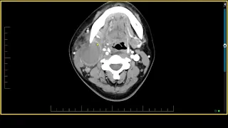 Salivary Glands - Mucoepidermoid Carcinoma