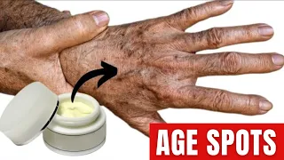 Amazing  Oil Removes AGE SPOTS Forever!