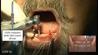 Implant Surgical Procedure with 4 Implants - Huge A-P Spread for Overdentures!