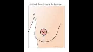 What is Breast Reduction? | Breast Reduction Demonstration | The Plastic Surgery Clinic