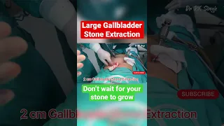 Largest Gallbladder Stone Extraction #viral #viralvideo #shorts #shortsvideo #gallstones