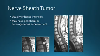 Spine Tumors