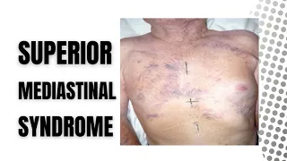 Superior Mediastinal Syndrome || Superior Venacaval Syndrome