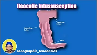 Ileocolic Intussusception