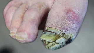 WHAT'S GROWING ON HIS FOOT? ***THICK SKIN OR FUNGUS?***