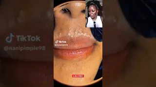 An Acne Sufferer REACTS to VIRAL TIKTOK PIMPLE POPPING VIDEO (lip acne) | Blackhead Extraction