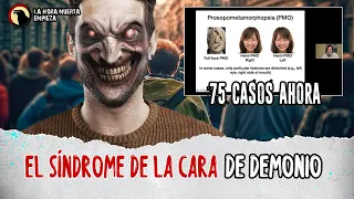 El síndrome de LA CARA DE DEMONIO (REAL)