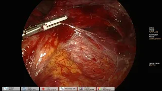 Laparoscopic ileocolic resection, Crohn's, J-I fistula