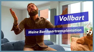 Barthaartransplantation in der Türkei | 6 Monate Post Op Update