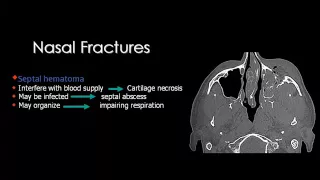 Imaging of Maxillo facial trauma Sep 2013   Dr Mamdouh Mahfouz In Arabic