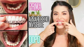 ADDIO DENTI STORTI! 10 COSE CHE DEVI SAPERE SULL' APPARECCHIO INVISIBILE! | Adriana Spink