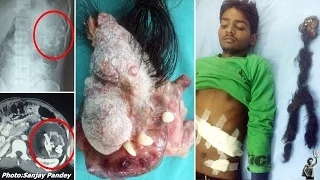 Horror As Doctors Find 20kg Parasite Twin With Teeth And Hair In Boy’s Stomach