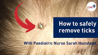 How to safely remove a tick from your child (or yourself!)