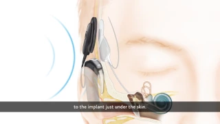 How a Cochlear™ Implant works with the Nucleus 6 Sound Processor